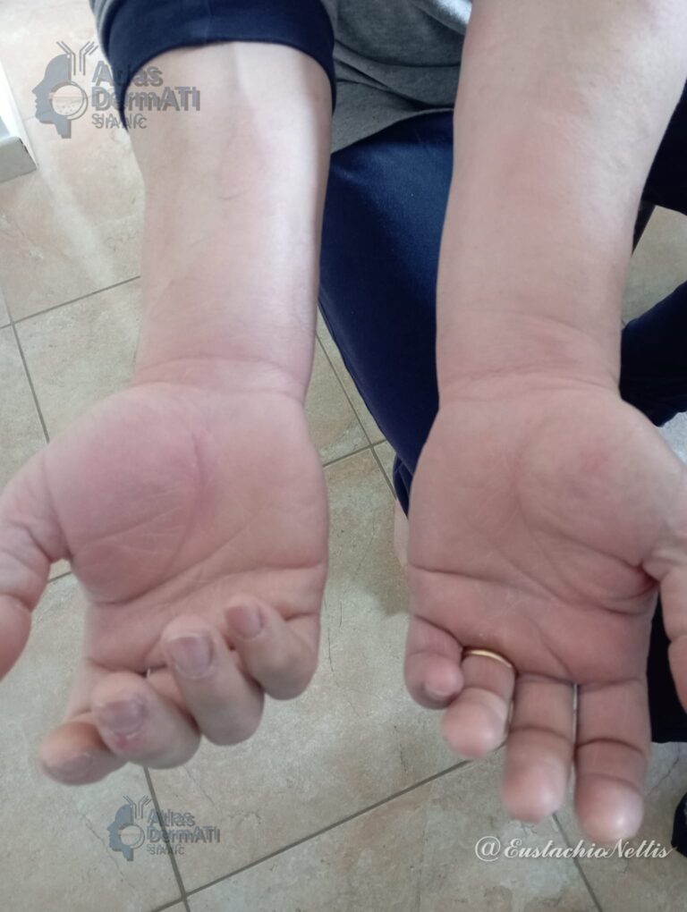Orticaria e angioedema da assunzione di Ketoprofene-Nettis E - Foto 1