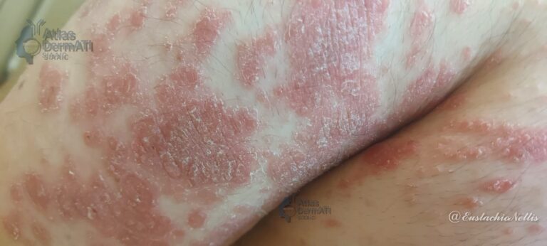 Psoriasi - Nettis