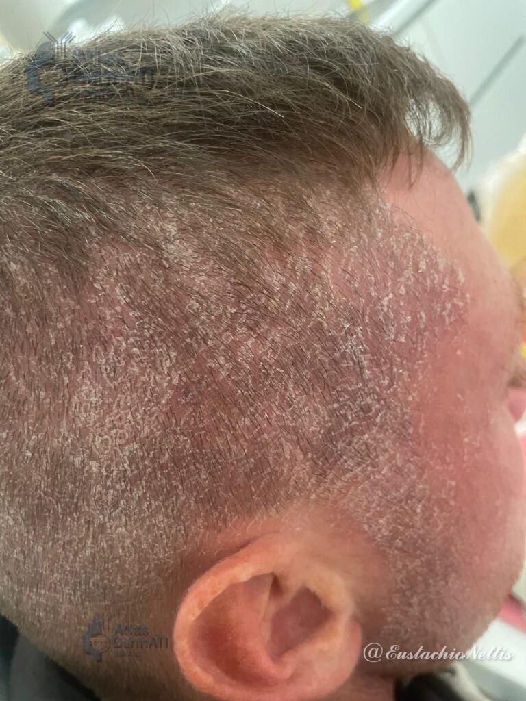Psoriasi cuoio capelluto- Nettis e Foto 1