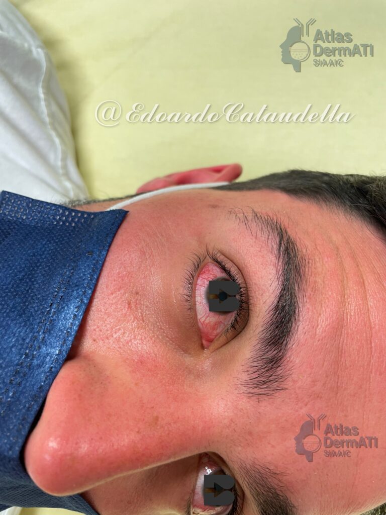 Sindrome Sgombroide foto 1 - Edoardo Cataudella