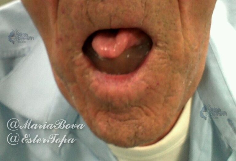 Angioedema da ACE-inibitore