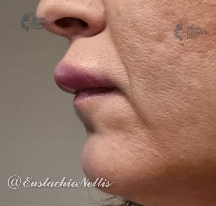 Angioedema da Ibuprofene