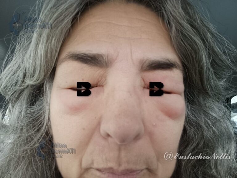 Angioedema da Ketoprofene