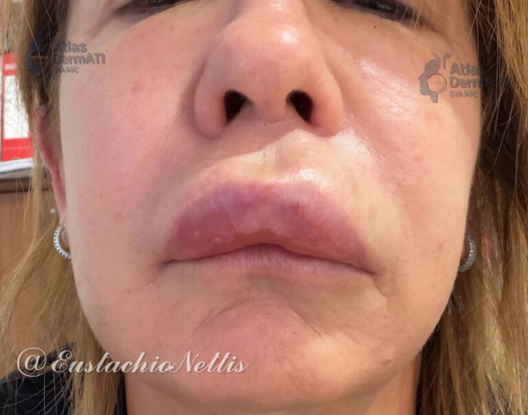 Angioedema ricorrente idiopatico istaminergico.
