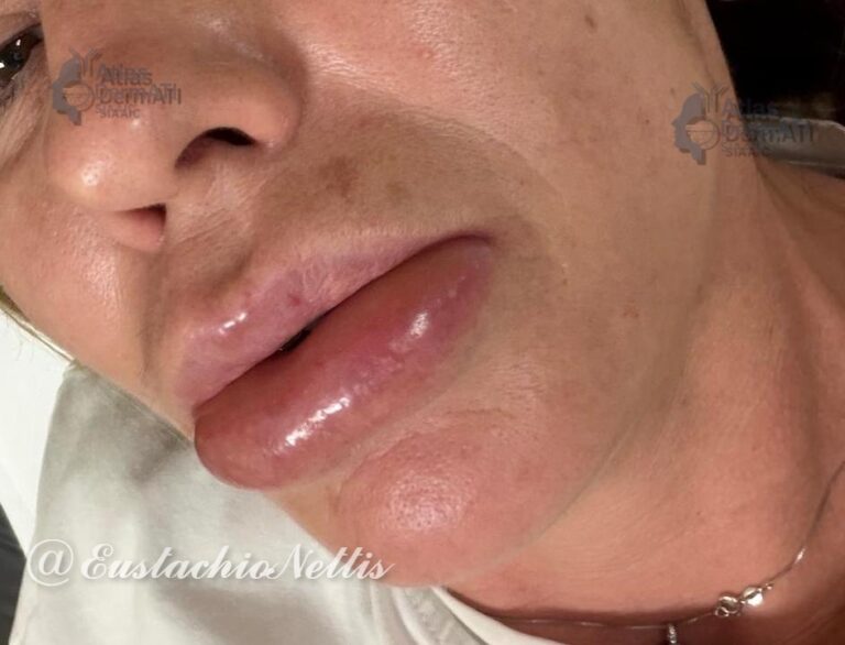 Angioedema ricorrente istaminergico.