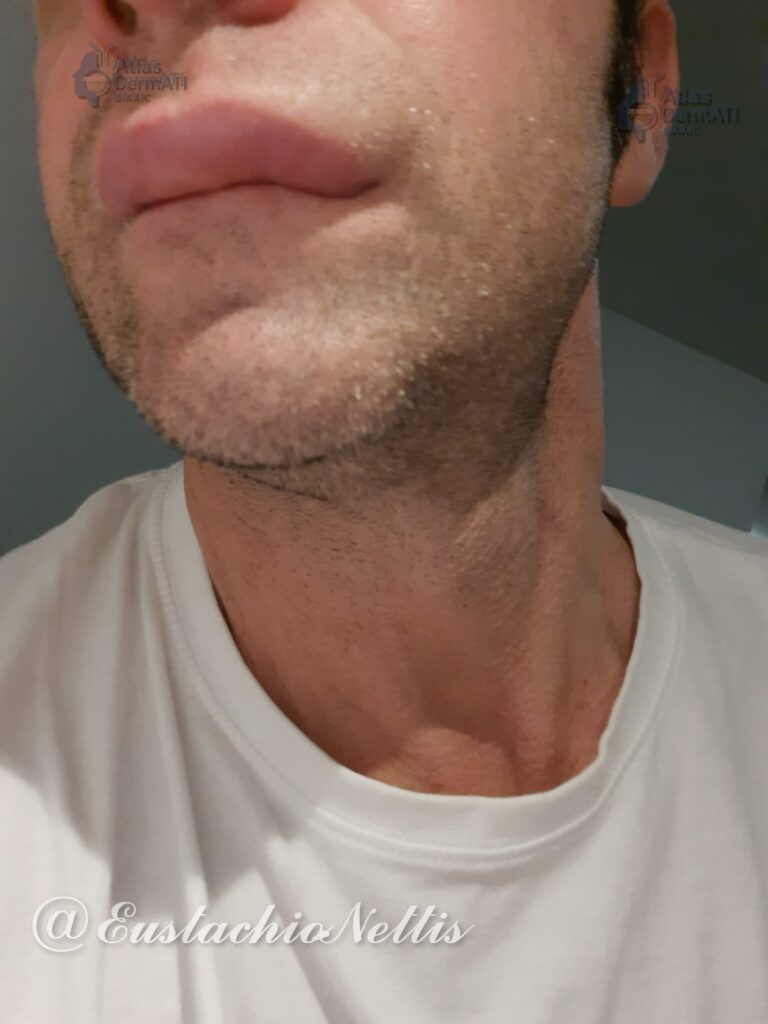 Angioedema ricorrente istaminergico