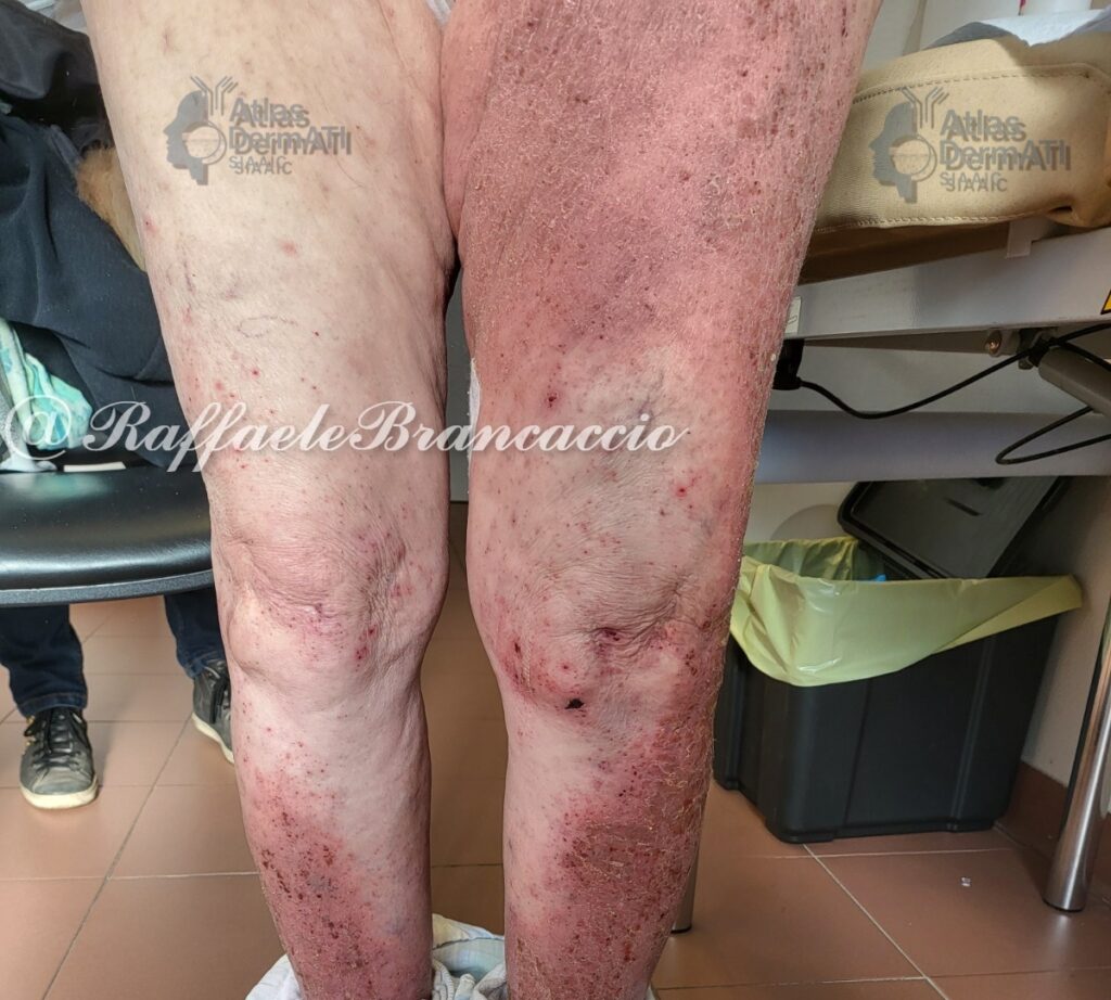 Dermatite atopica severa