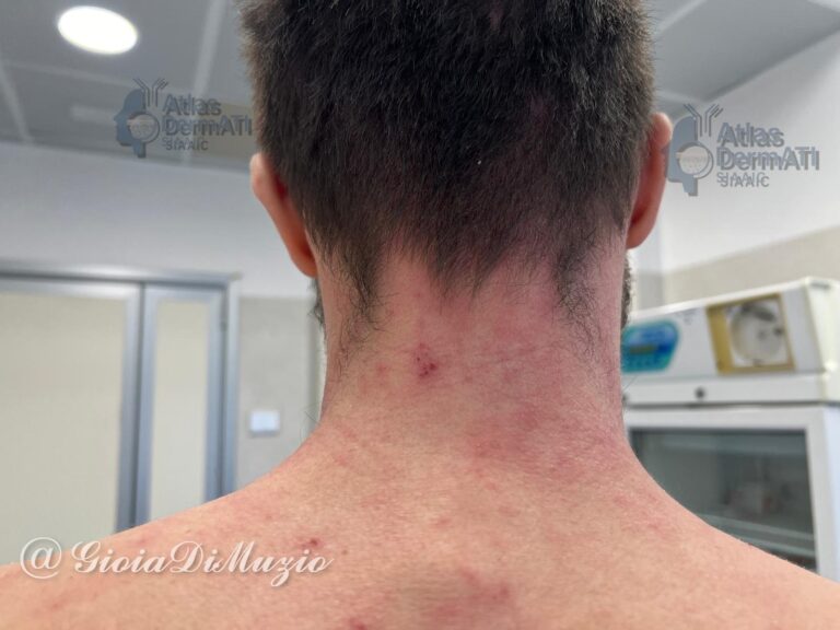 Dermatite atopica