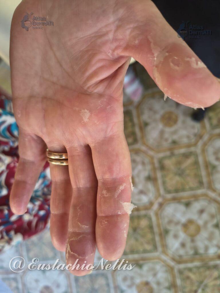 Eczema cronico delle mani -E Nettis - Foto 1