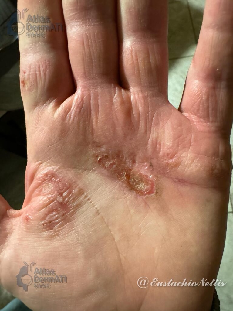 Eczema cronico delle mani