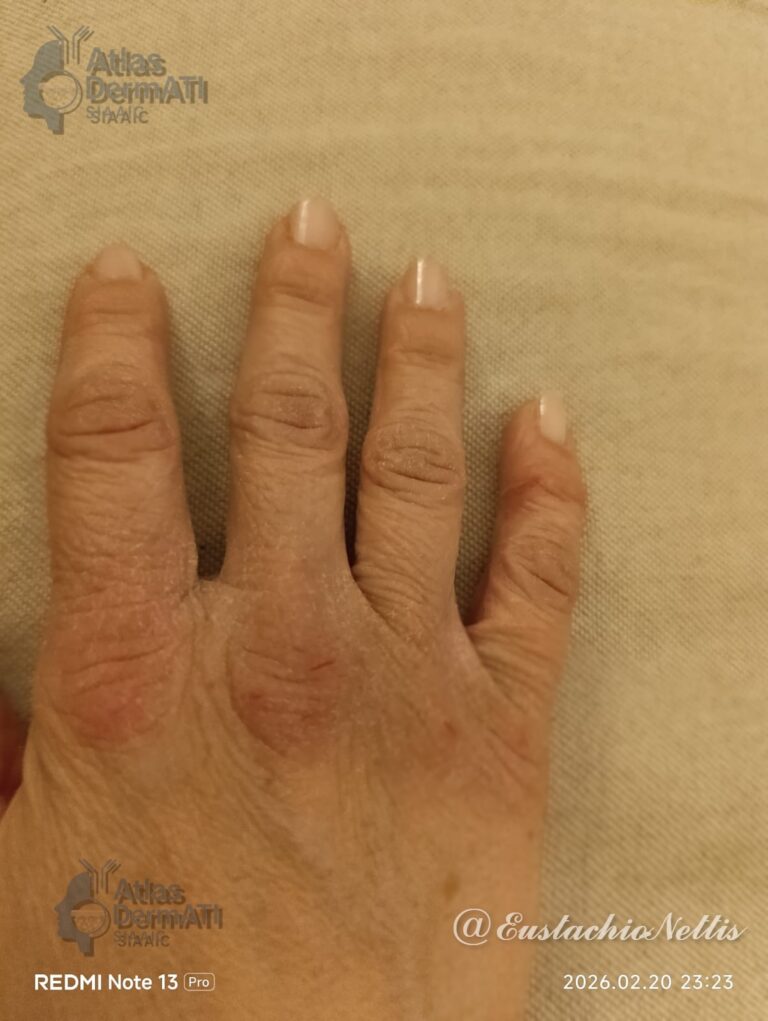 Eczema cronico delle mani