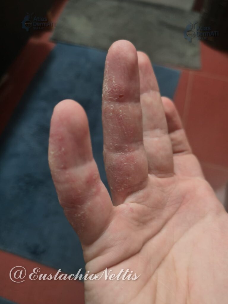• Eczema cronico delle mani in paziente affetto da dermatite atopica