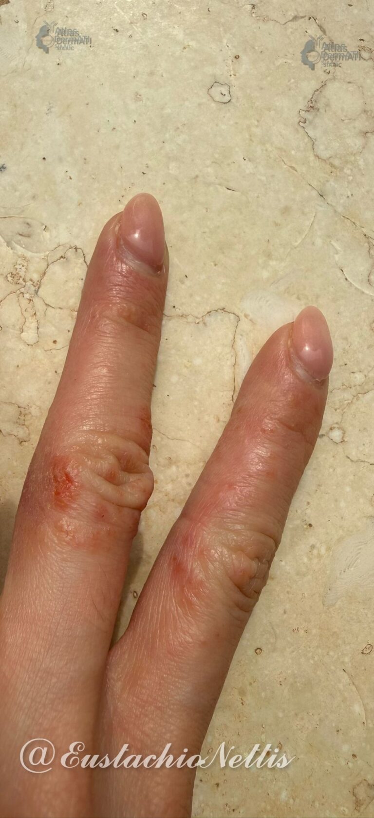 Eczema disidrosico