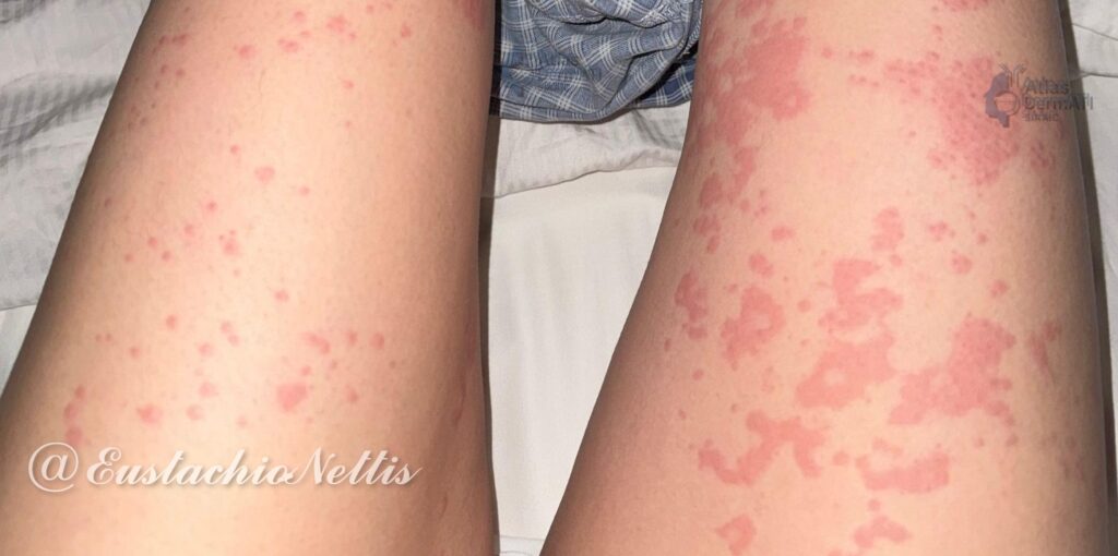 Orticaria colinergica