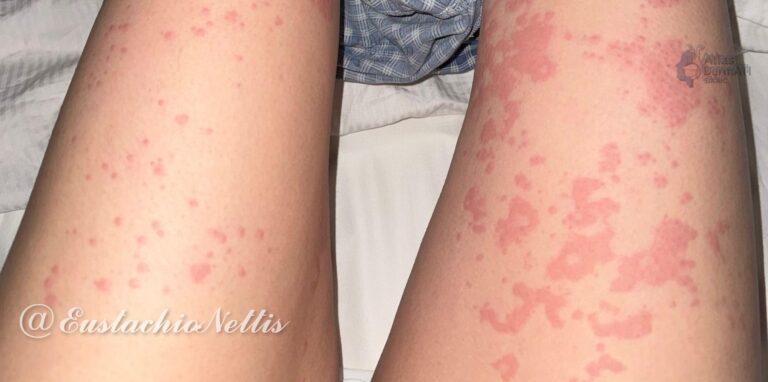 Orticaria colinergica