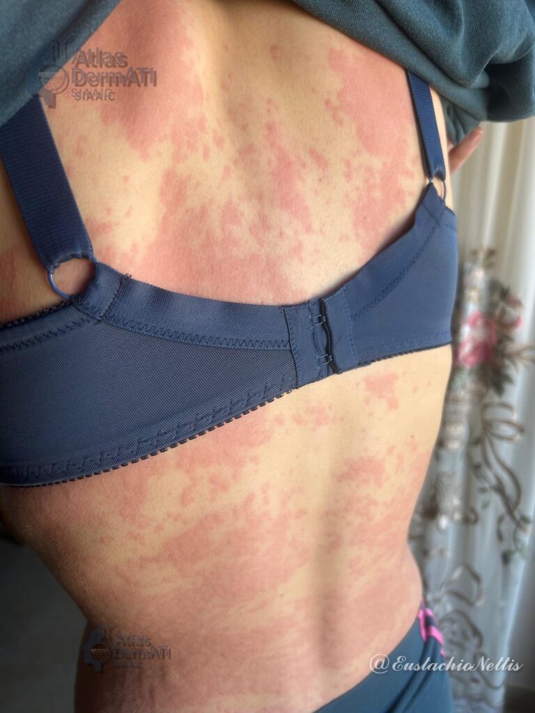 Orticaria cronica spontanea