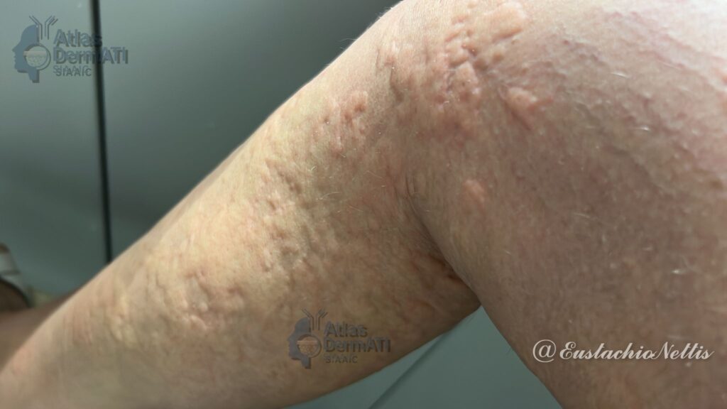 Orticaria acuta da alimenti