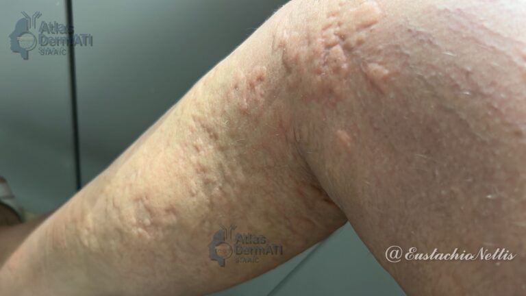 Orticaria acuta da alimenti
