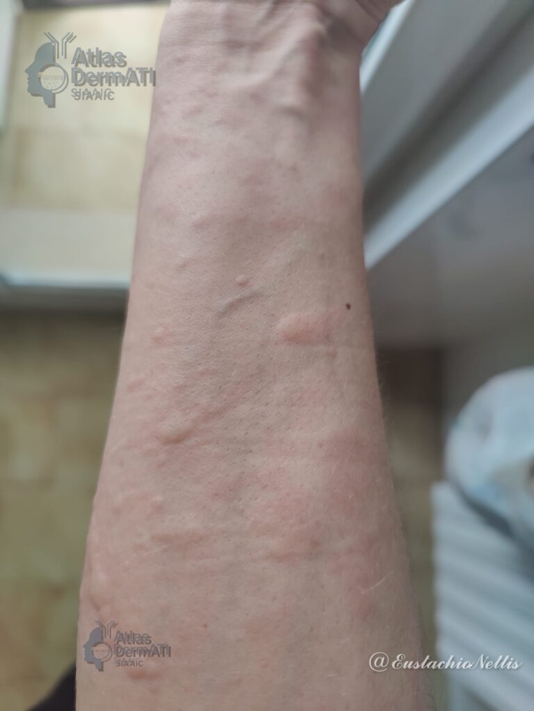 Orticaria cronica