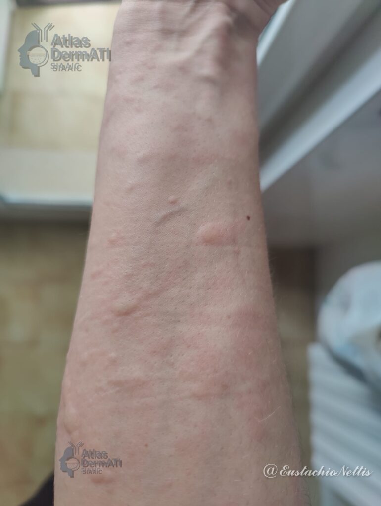 Orticaria cronica