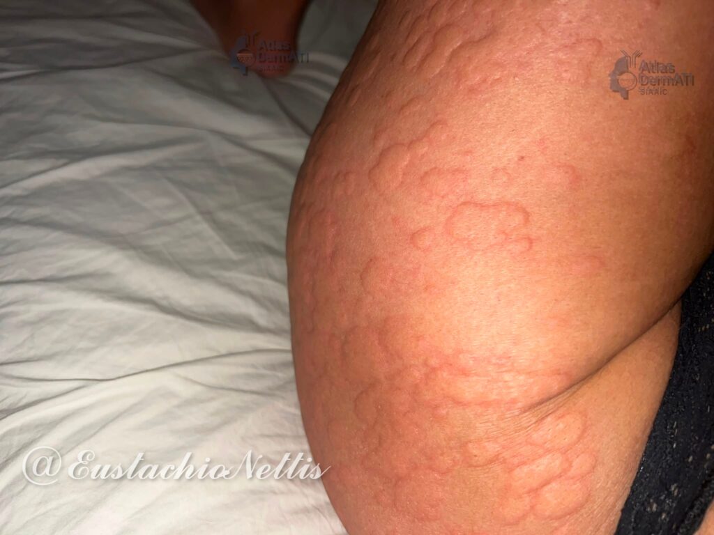 Orticaria cronica spontanea