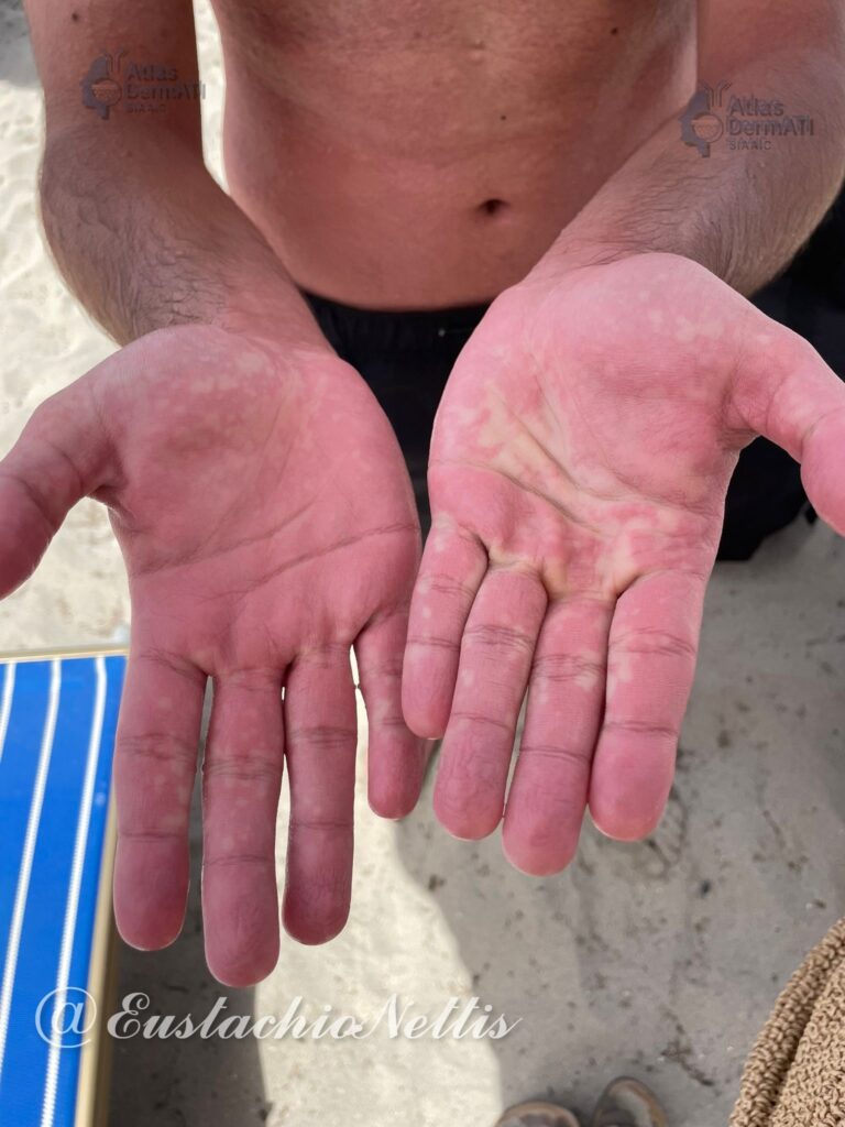Orticaria da freddo