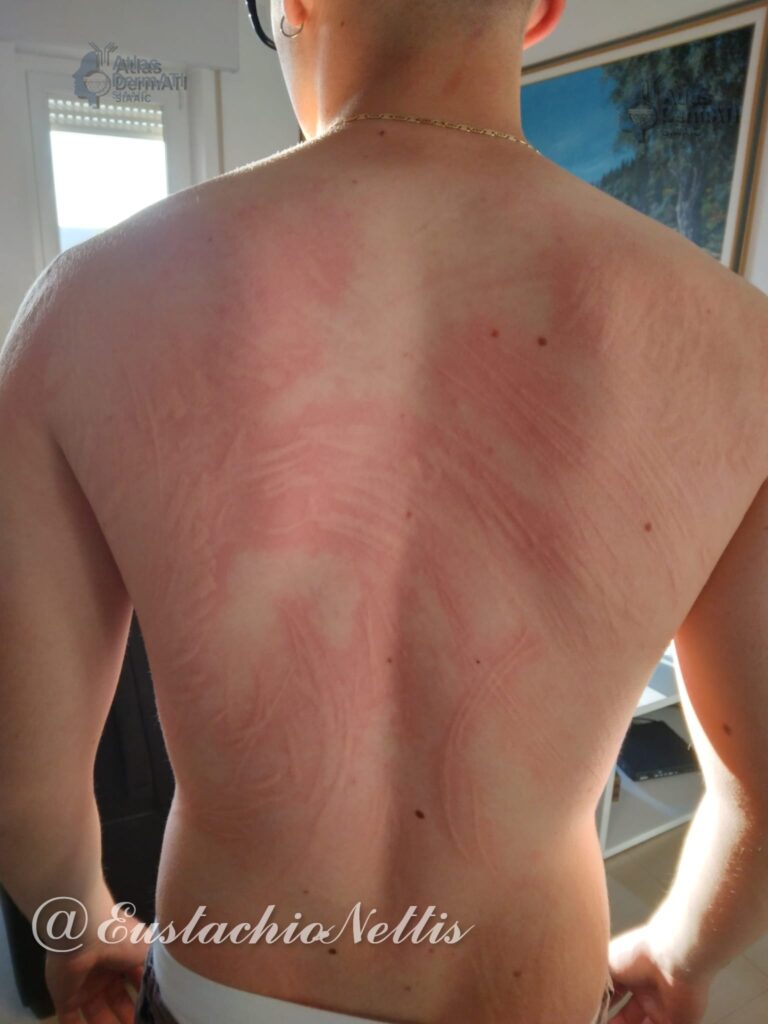 Orticaria dermagrafica
