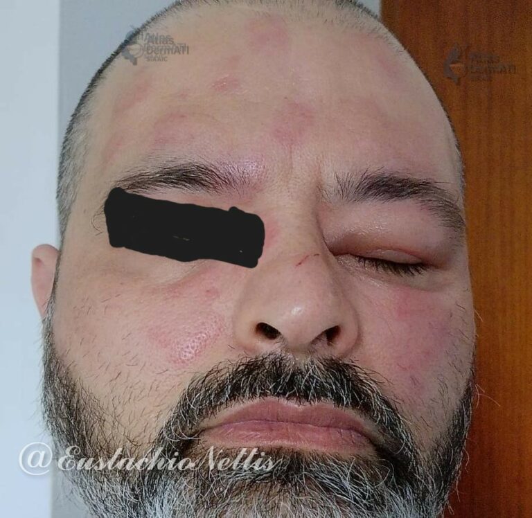 Orticaria e angioedema cronici