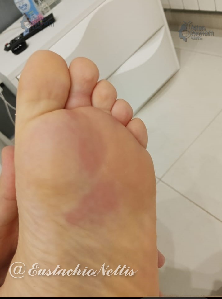 Orticaria ritardata da pressione