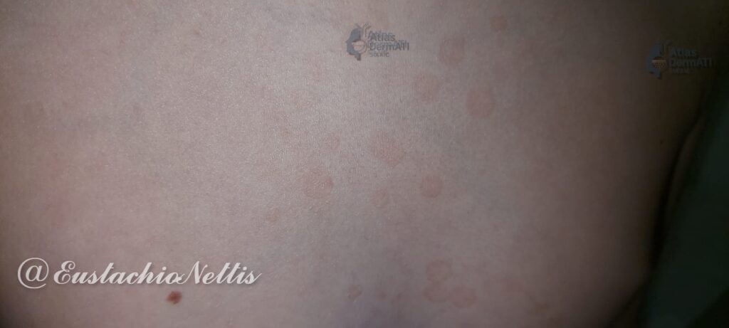 Pityriasis versicolor