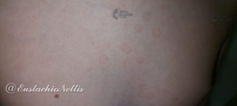 Pityriasis versicolor