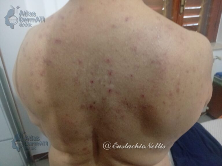 Prurigo nodularis - Nettis 2
