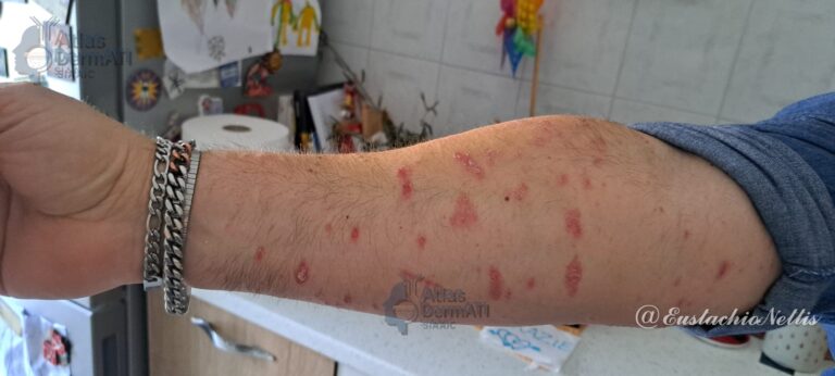 Psoriasi