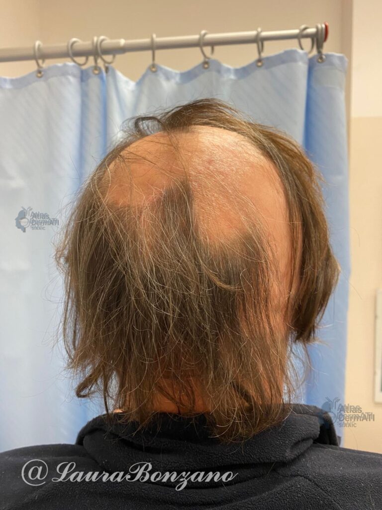 Alopecia areata