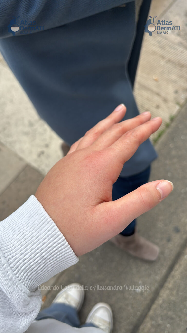 Angioedema Ereditario Mano