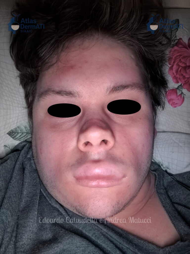 Angioedema ereditario