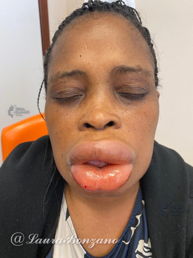 Angioedema correlato all’assunzione di FANS orali.