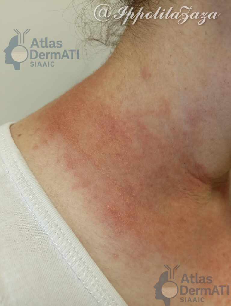 Dermatite allergica da contatto da Diclofenac