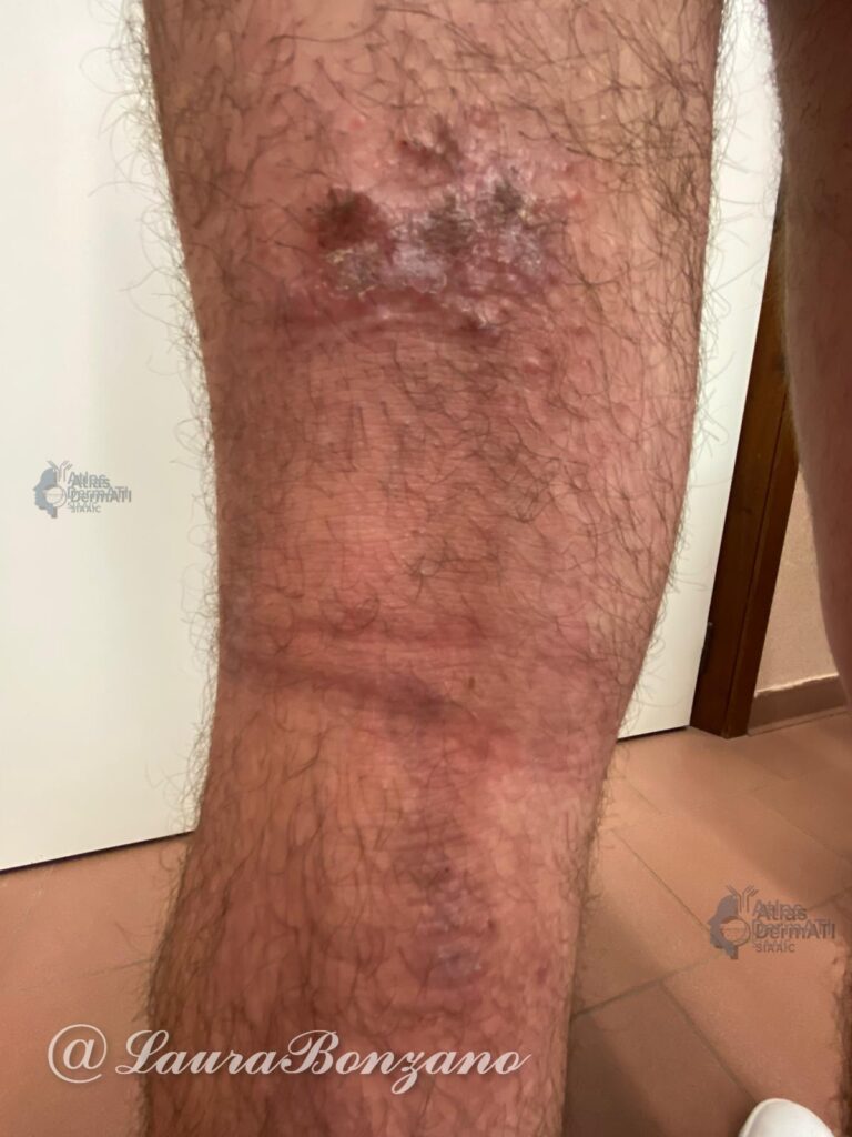 Dermatite atopica