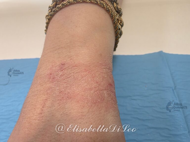 Dermatite atopica