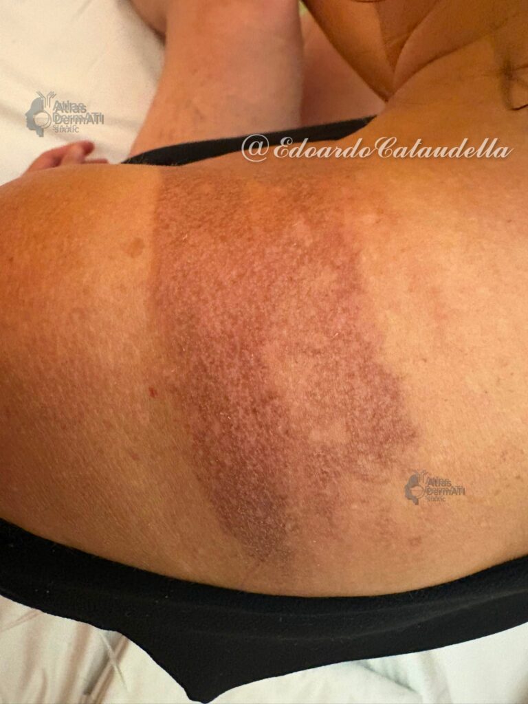 Dermatite da fotosensibilità in terapia con Infliximab