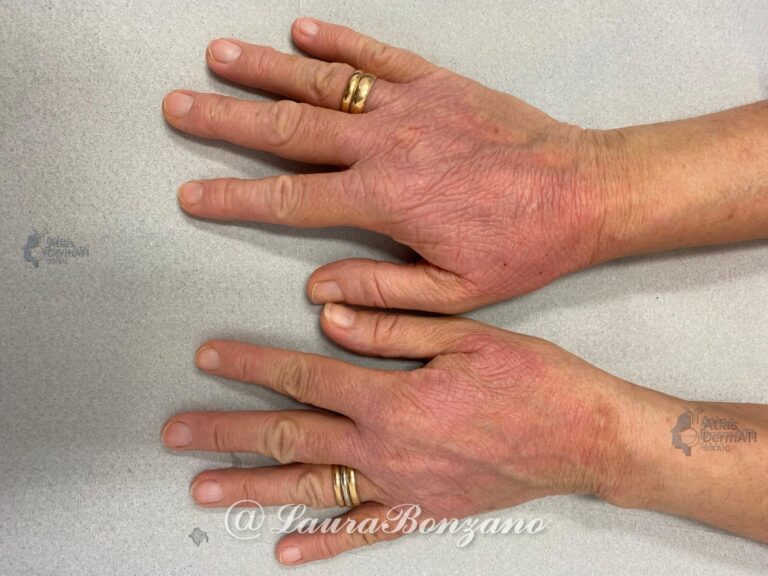 Eczema cronico delle mani
