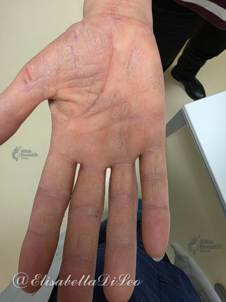 Eczema cronico delle mani