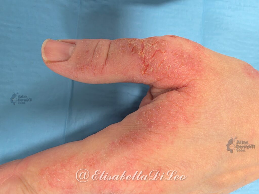 Eczema cronico delle mani