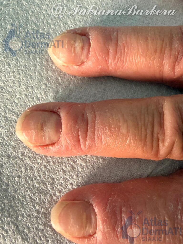 Eczema cronico delle mani