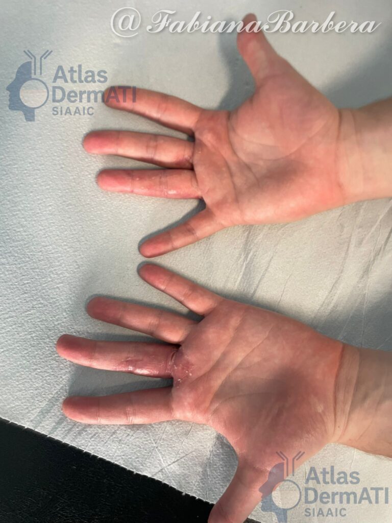 Eczema cronico delle mani