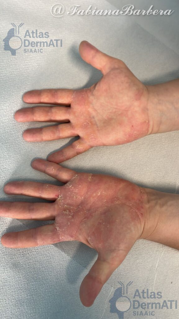 Eczema cronico delle mani