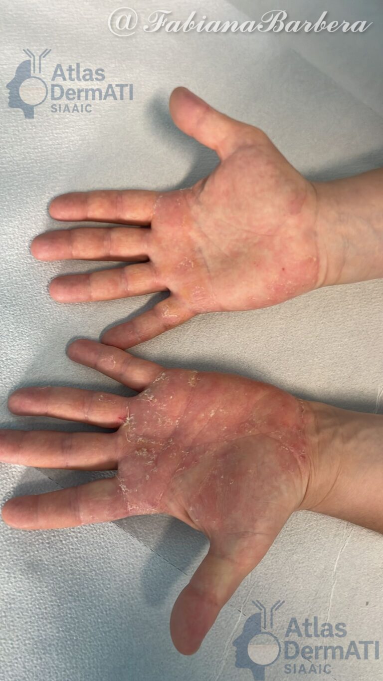 Eczema cronico delle mani