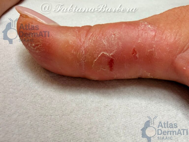 Eczema cronico delle mani