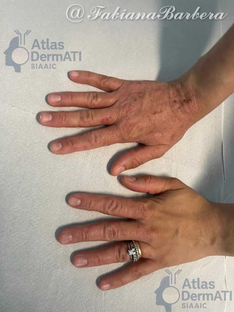 Eczema cronico delle mani